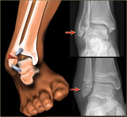 patah ankle saat badminton