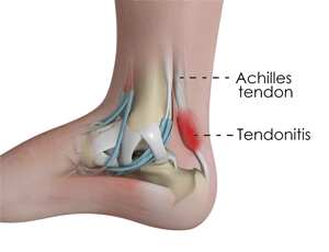cedera ankle tendinitis